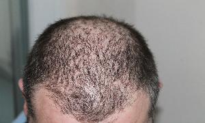 No 1 Tip For Hair Loss Problem